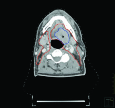 Corte axial de TC contrastada mostrando delineación de GTV y CTV en carcinoma de base de lengua VPH-positivo con extensión hacia línea media