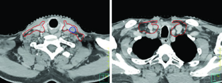 Cortes axiales de TC contrastada mostrando GTV y CTV en carcinoma amigdalino VPH-negativo cT4N2 con cobertura de láminas pterigoideas y nivel IB