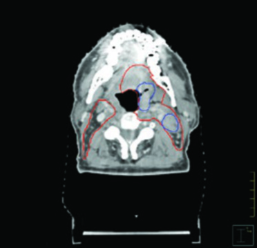 Corte axial de TC mostrando cobertura ganglionar hasta base de cráneo en el lado N-positivo en carcinoma de base de lengua VPH-asociado