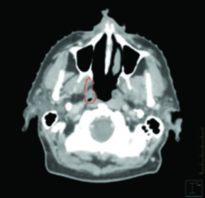 Corte axial de TC mostrando planificación de radioterapia unilateral en carcinoma amigdalino VPH-positivo cT2N0 con cobertura ipsilateral de base de lengua y paladar blando
