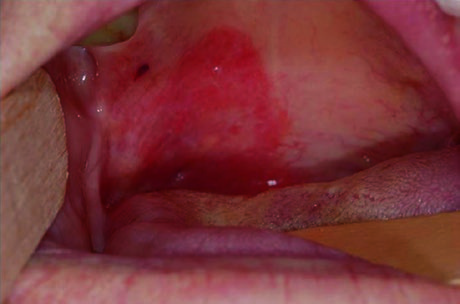 Carcinoma de Orofaringe: Delineamento e Campos