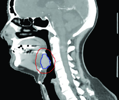 Corte sagital de TC mostrando cobertura del espacio preepiglótico en tumor de base de lengua con GTV en azul y CTV en rojo