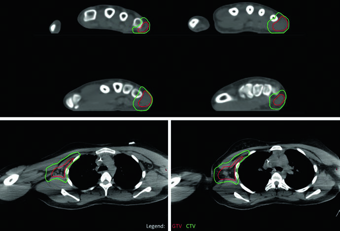 Delineamento de rabdomiossarcoma alveolar de extremidade superior com metástases axilares em TC de simulação