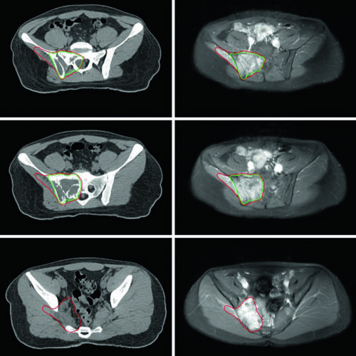 Sarcoma Pediátrico: Delineamento na RT