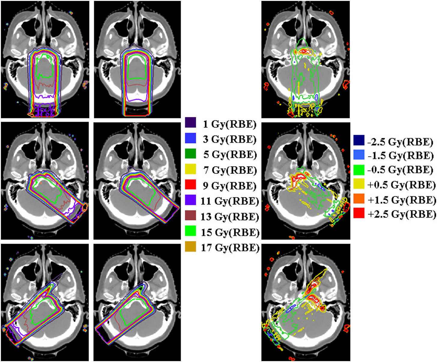 Distribuição de dose de prótons em CT craniano mostrando isodoses de 1 a 17 Gy(RBE) e mapa de diferença de dose entre algoritmos para caso de meningioma