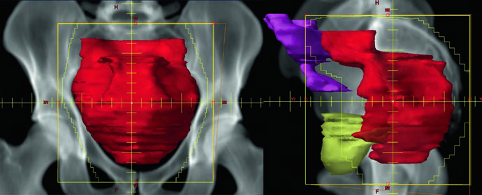 Standard 3D conformal radiotherapy fields for T3N1b rectal cancer: PA and left lateral fields with CTV-SR, small bowel displaced by belly board
