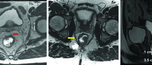 Câncer Retal: Delineamento e Campos na RT