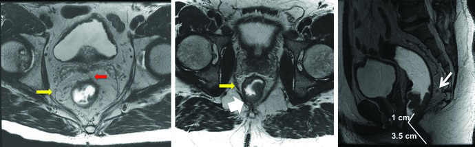 Rectal Cancer: Target Delineation and Fields