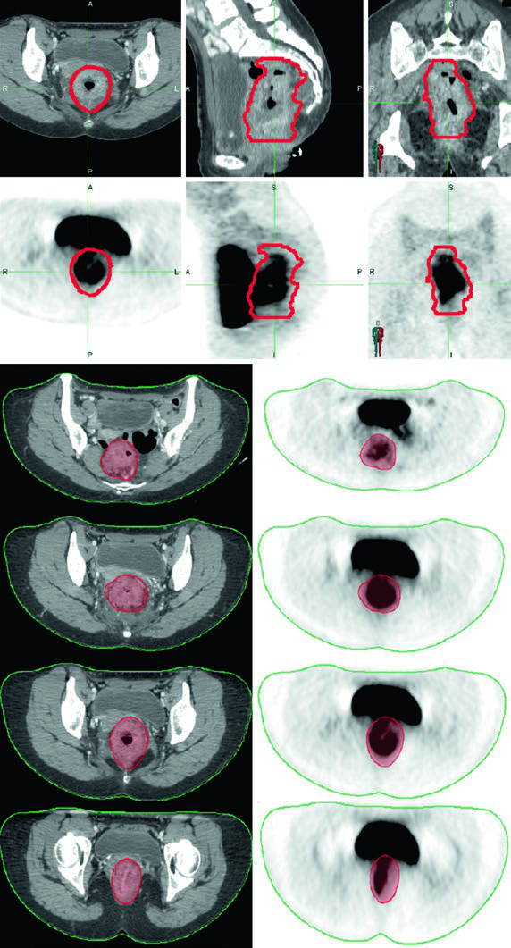 Co-registered CT and PET images for clinical T4N0 rectal adenocarcinoma with cervical invasion, showing GTV on axial, sagittal, and coronal views