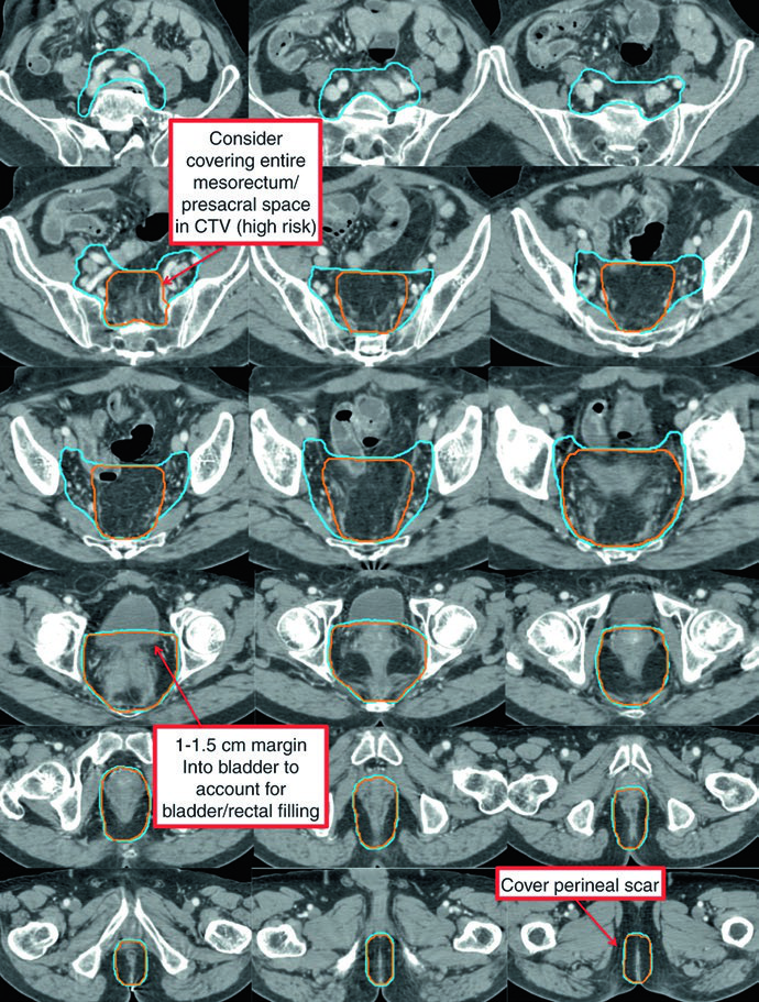 Postoperative target delineation after abdominoperineal resection showing CTV-SR and CTV-HR including surgical bed and perineal scar