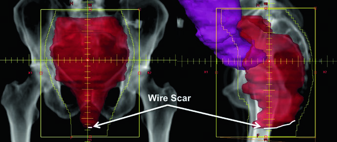 3D conformal fields for postoperative rectal cancer after abdominoperineal resection: PA and lateral fields with CTV-SR including perineal scar