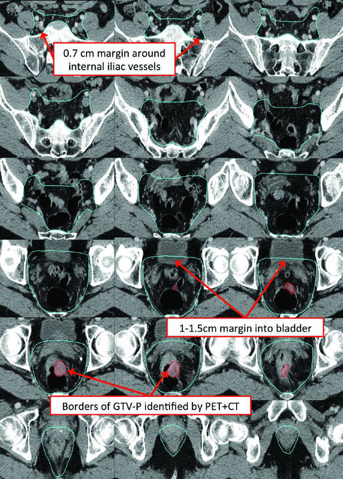 Short-course preoperative radiotherapy delineation for T3N0 rectal cancer showing CTV-SR and GTV on PET/CT simulation