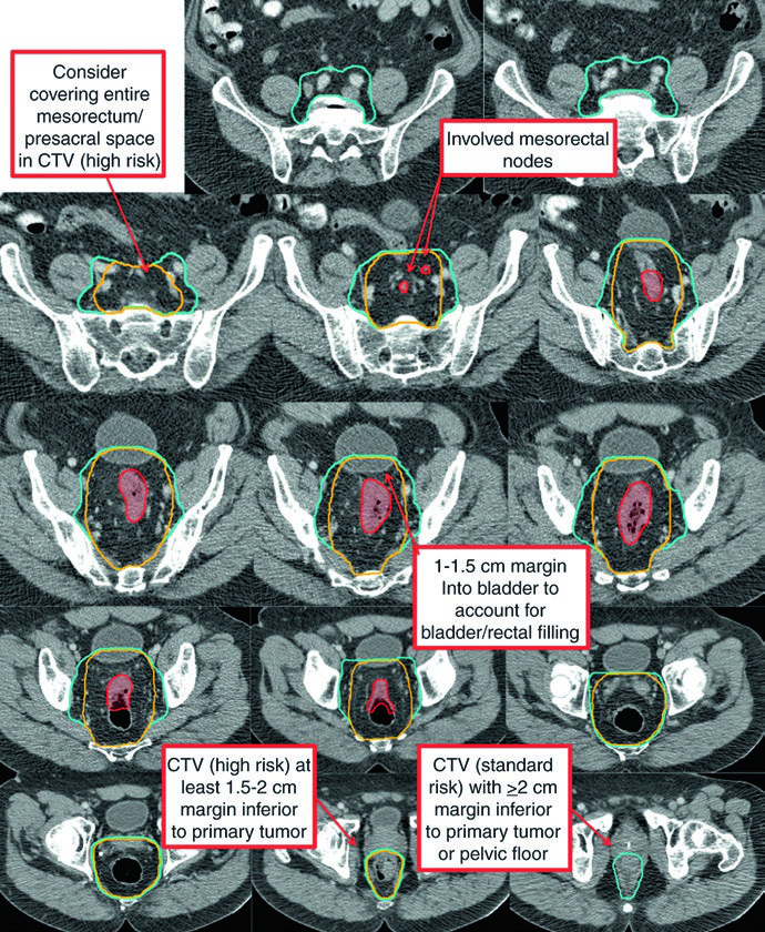 Complete target delineation for T3N1b rectal adenocarcinoma showing CTV-SR, CTV-HR, GTV-N, and GTV-P on PET/CT simulation