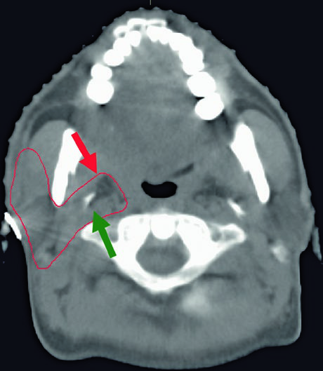 CT bone window of the skull base showing foramen ovale, cochlea, vestibule, internal auditory canal, and semicircular canals identified by color overlays
