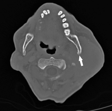 CT bone window showing periosteal reaction at the posterior aspect of the left mandibular ramus (white arrow), suggesting bone involvement by salivary gland tumor