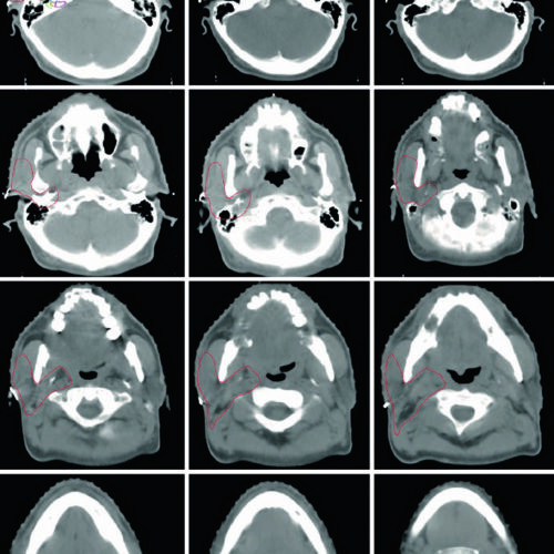 Glándulas Salivales: Delineación y RT