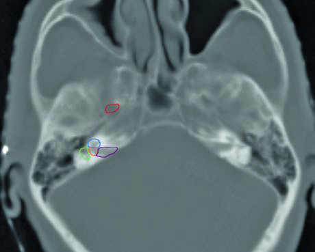 Axial CT showing the parapharyngeal space (red arrow) and retrostyloid space (green arrow) in relation to the parotid gland