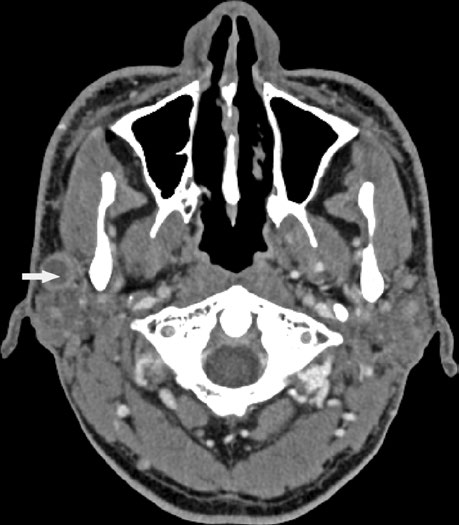 Axial contrast-enhanced CT showing right parotid mass (metastatic squamous cell carcinoma) indicated by white arrow