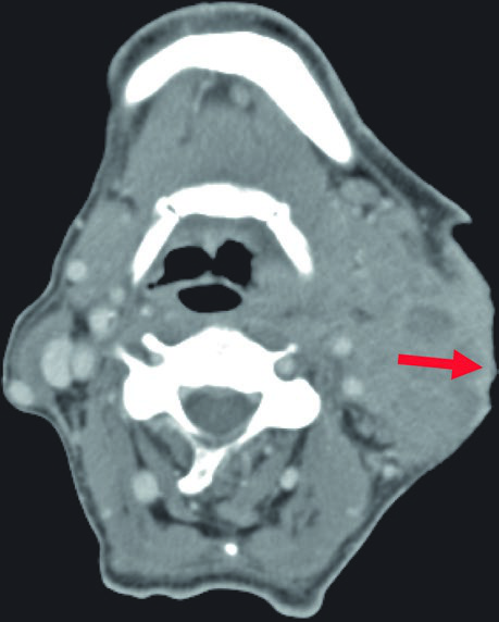 Axial contrast-enhanced CT of the neck showing evidence of dermal infiltration in the parotid region (red arrow) indicating need for skin as a target structure