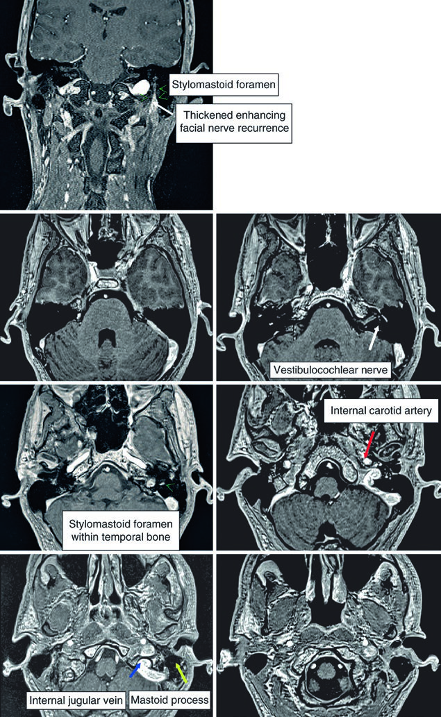 Contrast-enhanced T1-weighted MRI showing perineural recurrence of mucoepidermoid carcinoma of the left parotid gland infiltrating the facial nerve through the stylomastoid foramen (green arrowheads)