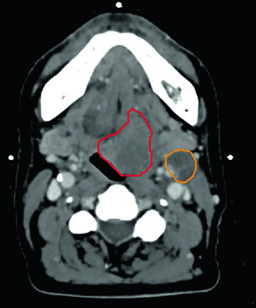 Axial CT with primary GTV and nodal GTV delineation in T2N1 base of tongue carcinoma treated with SBRT