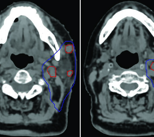 SBRT em Cabeça e Pescoço: Técnica e Casos