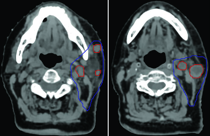 Axial CT with CTV and GTV delineation in centenarian patient with cervical recurrence treated with SBRT
