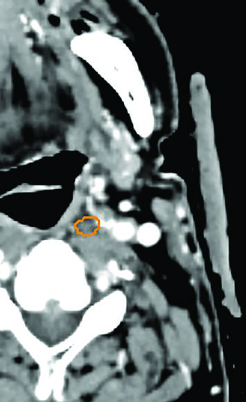 Double-contrast CT simulation showing improved GTV visualization in base of tongue carcinoma for SBRT planning