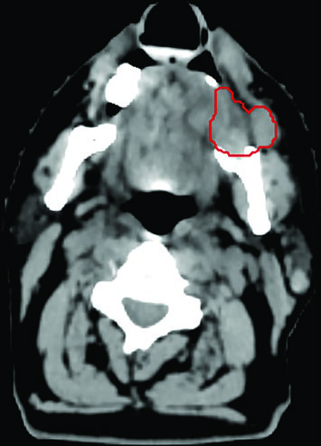 CT and MRI fusion for head and neck recurrence delineation showing discordant post-treatment imaging findings