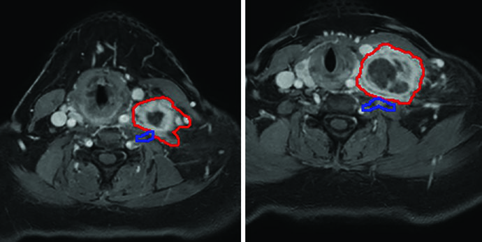 SBRT plan with MRI fusion showing GTV adjacent to brachial plexus in the supraclavicular fossa