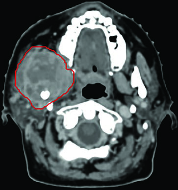 Axial CT showing GTV contour in extensive oral cavity carcinoma treated with SBRT 45 Gy in 5 fractions