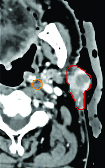Sagittal CT showing primary parotid tumor and retropharyngeal nodes delineated for SBRT 50 Gy in 5 fractions
