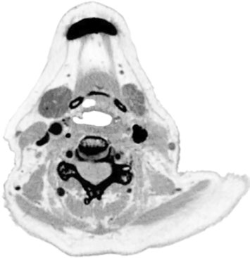 Axial CT of squamous cell carcinoma of the piriform sinus with GTV delineation for head and neck SBRT