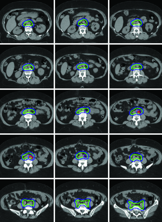 Patient with FIGO stage IB endometrioid adenocarcinoma treated with extended field IMRT and ITV technique with simultaneous integrated boost (SIB) of 5940 cGy to gross para-aortic nodal disease