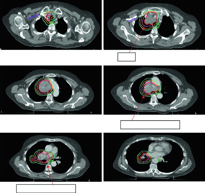 Planejamento de radioterapia no carcinoma de pequenas células do pulmão