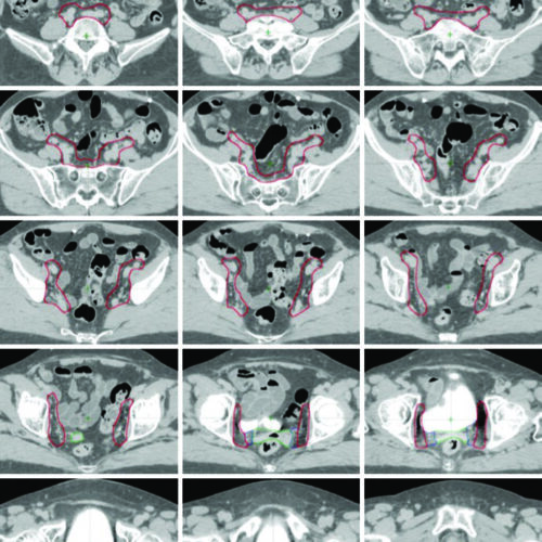 RT Pós-Operatória Ginecológica: Delineamento