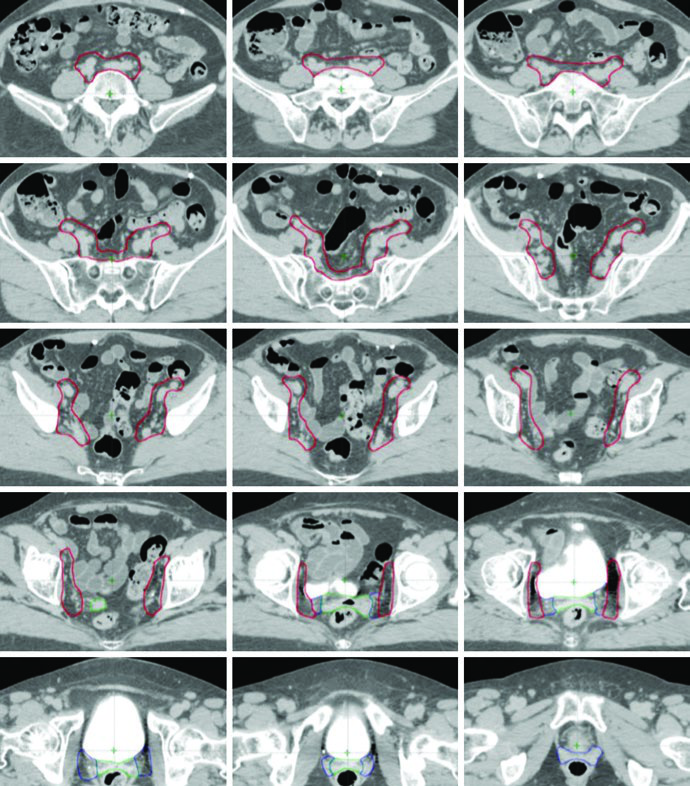 Three clinical target volumes (CTV1, CTV2, CTV3) delineated in a patient with cervical cancer after radical hysterectomy and pelvic lymphadenectomy
