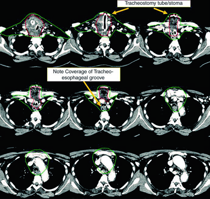 Cortes axiais adicionais de TC mostrando extensão do CTV em carcinoma anaplásico de tireoide com invasão de estruturas adjacentes