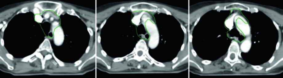 Cortes adicionais da TC de planejamento do câncer de tireoide pouco diferenciado mostrando extensão do CTV no mediastino superior