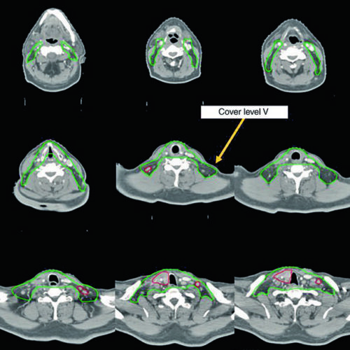 Câncer de Tireoide: Delineamento na Radioterapia