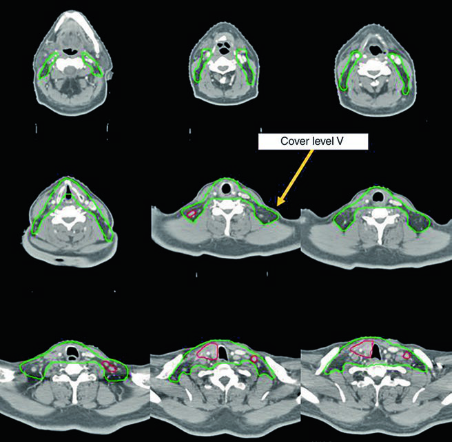 Câncer de Tireoide: Delineamento na Radioterapia