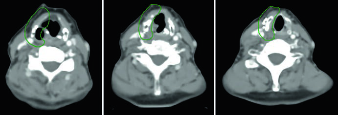 Cortes de TC mostrando CTV 60 Gy em câncer de tireoide pouco diferenciado com omissão do tratamento do pescoço lateral
