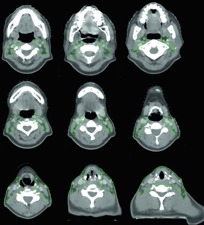 Cortes axiais de TC mostrando CTV pós-operatório em carcinoma anaplásico de tireoide com extensão extratireoidiana e margens positivas