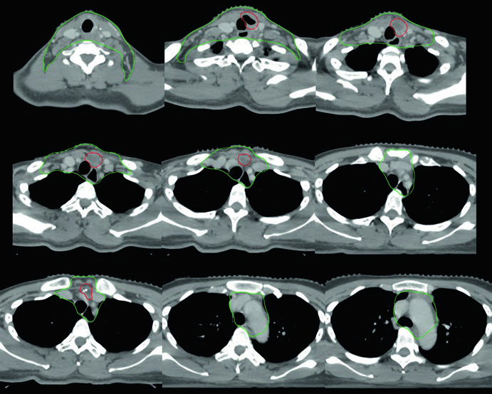 Cortes de TC de planejamento pós-operatório em anaplásico de tireoide com clips cirúrgicos e CTV 70 Gy demarcado