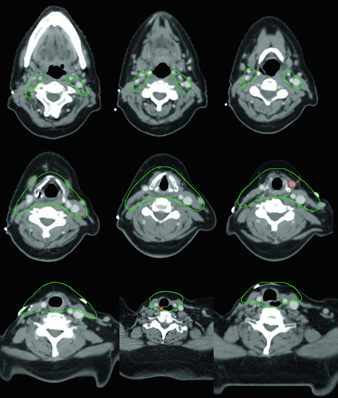 Cortes axiais mostrando GTV 70 Gy e CTV 60 Gy em recorrência multifocal de carcinoma papilar de tireoide variante células altas