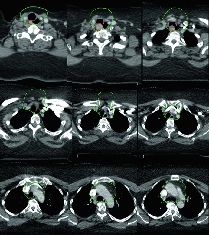 Cortes adicionais da TC de planejamento em recorrência multifocal de carcinoma papilar com GTV e CTV demarcados