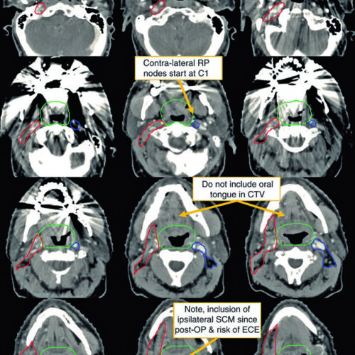 Primário Oculto em Cabeça e Pescoço: Planejamento RT