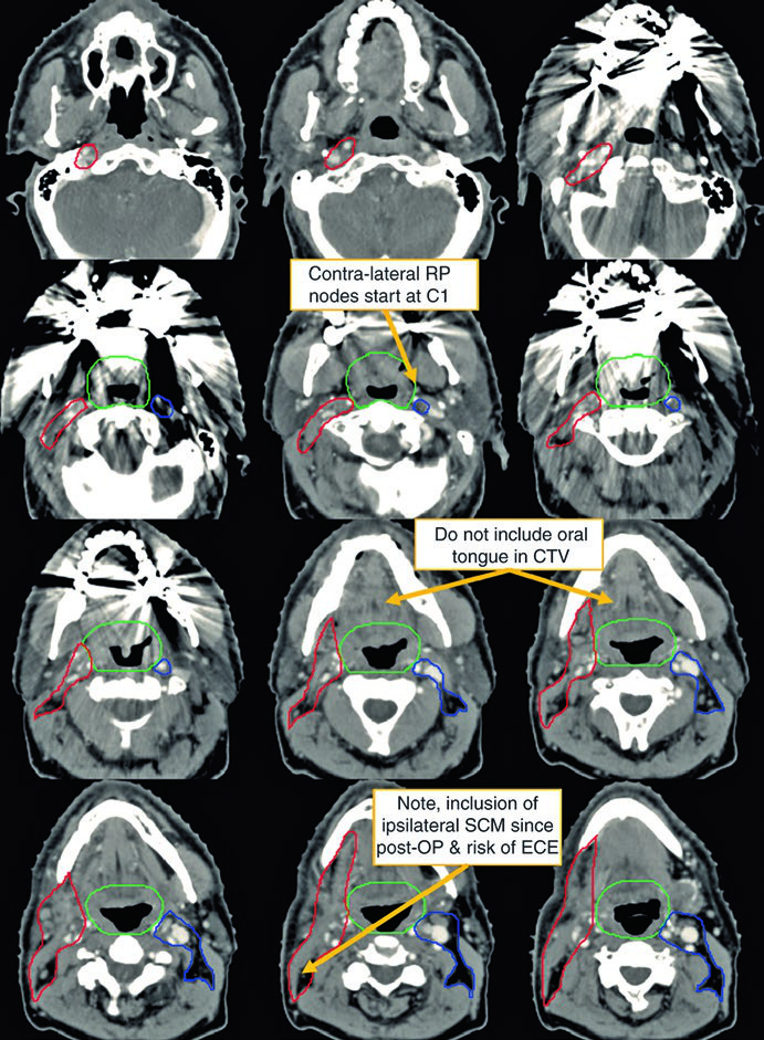 Cortes axiais de TC de planejamento mostrando delineamento de CTV66 em vermelho, CTV54-60 em verde e CTV54 em azul para primário oculto pós-operatório em cabeça e pescoço
