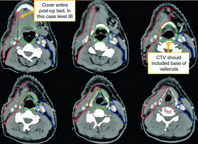 Continuação dos cortes axiais de planejamento pós-operatório para primário oculto cervical com níveis linfonodais e cobertura faríngea delineados