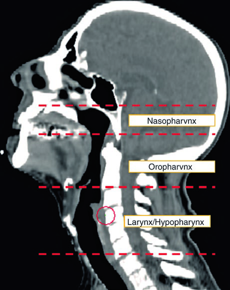 Imagem sagital mediana com marcos anatômicos delimitando nasofaringe, orofaringe e laringe/hipofaringe para planejamento radioterápico de primário oculto